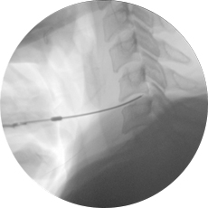 경추부 수핵성형술(Cervical)