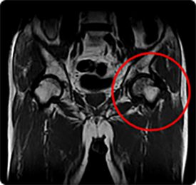 무혈성 대퇴골두 괴사증의 MRI