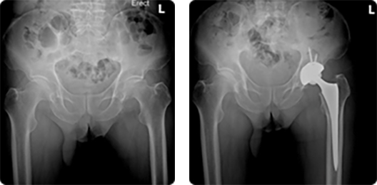 본원 의료진이 무혈성 대퇴골두 괴사증에 대하여 시행한 고관절 치환술 예