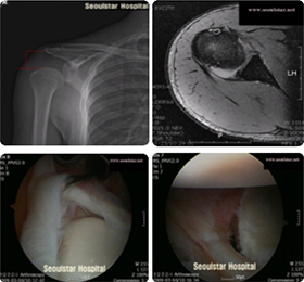 수술 전 견관절 탈구 및 관절낭 손상