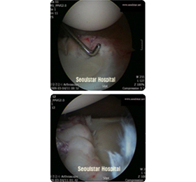 수술 후 관절경을 이용한 봉합술 시행