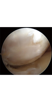 연골 손상을 복원 수술후