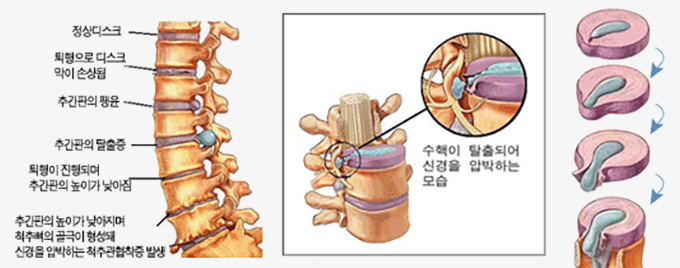 허리디스크