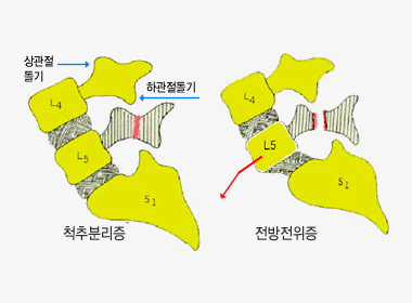 척추분리증(척추전방전위증)