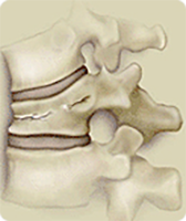 척추 압박골절