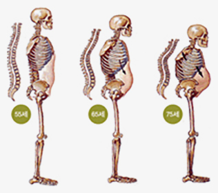 척추 압박골절을 치료하지 않고 방치하게 되면 어떻게 될까요?