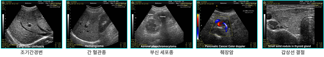 조기간경변, 간 혈관종, 부신 세포종, 췌장암, 갑상선 결절